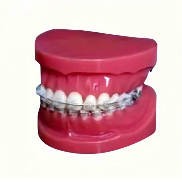UM-B17 Учебная модель с фиксированными брекетами на зубах (нормальный)