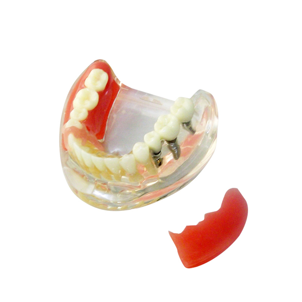 UM-Z11 Образовательная модель для зубного протеза имплантата